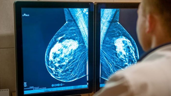 1729500880 474 Limpression 3D pour les patientes atteintes dun cancer du sein