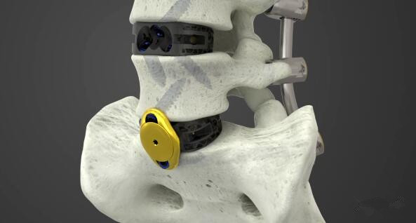 1731656060 334 Orthopedics giant globally launches 3D printing products