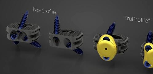 orthopedics giant globally launches 3d printing products