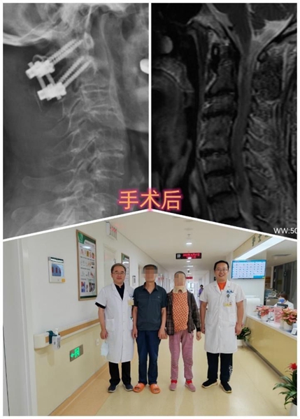 1731663637 169 3D printing technology enables high risk atlantoaxial surgery