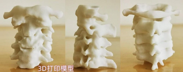 1731663637 247 3D printing technology enables high risk atlantoaxial surgery