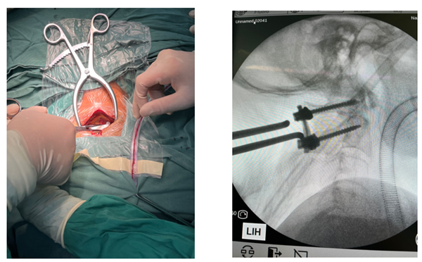 1731721112 726 Application of 3D printing to spine surgery