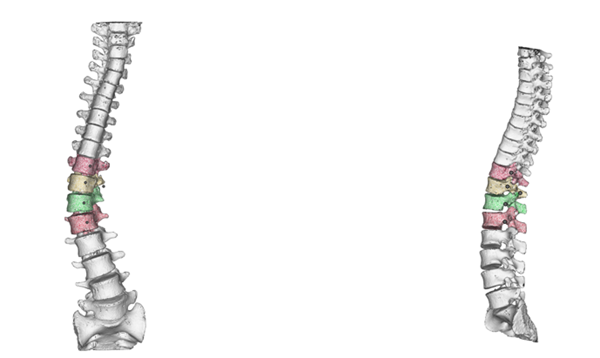 1731721113 3 Application of 3D printing to spine surgery