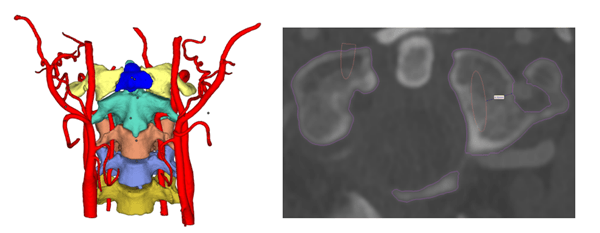 application of 3d printing to spine surgery