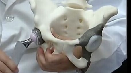 1731796412 411 Successful implementation of a personalized prosthesis using 3D printing for