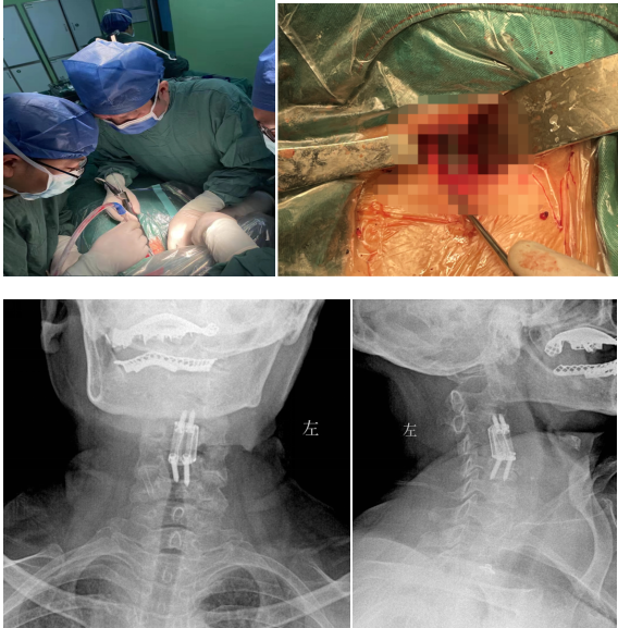 1732075076 517 Significant breakthrough in 3D printing technology for spine surgery