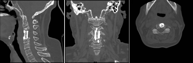 1732075077 381 Significant breakthrough in 3D printing technology for spine surgery