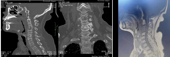 significant breakthrough in 3d printing technology for spine surgery