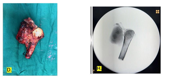 1732109309 665 3D printed osteotomy guide plate and custom prosthesis for personal
