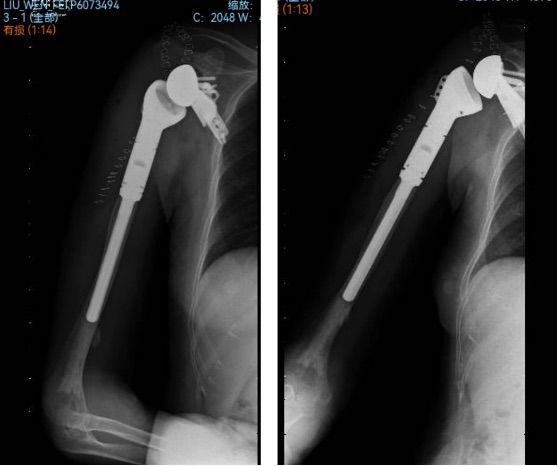 1732109310 112 3D printed osteotomy guide plate and custom prosthesis for personal