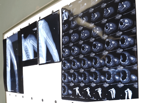 3d printing reverse shoulder replacement solves the problem of patients