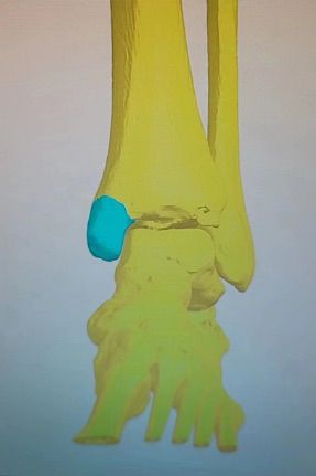 1732391775 328 Case 3D printing technology completes the design of the fracture