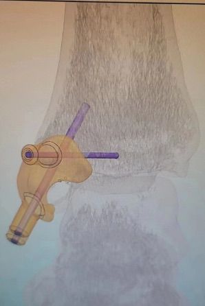 1732391776 234 Case 3D printing technology completes the design of the fracture