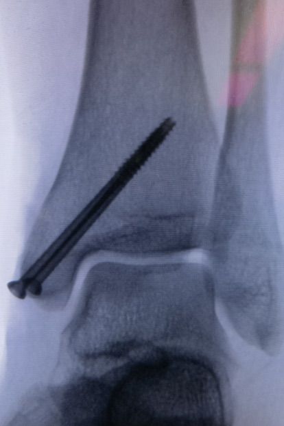 1732391776 475 Case 3D printing technology completes the design of the fracture