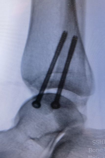 1732391777 261 Case 3D printing technology completes the design of the fracture