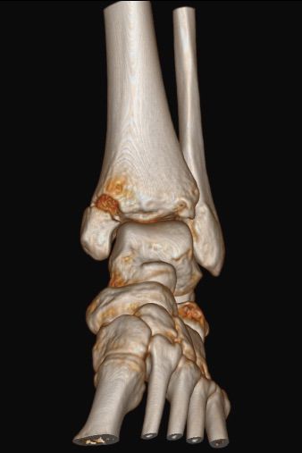 case! 3d printing technology completes the design of the fracture