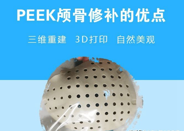 1732430348 581 Application of 3D PEEK in skull defects