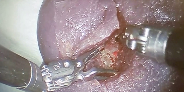 1732578040 208 Using 3D printing technology total ear canal resection surgery was