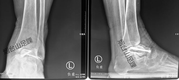 1732665514 6 The Foot and Ankle Surgery Department of Yantaishan Hospital performed