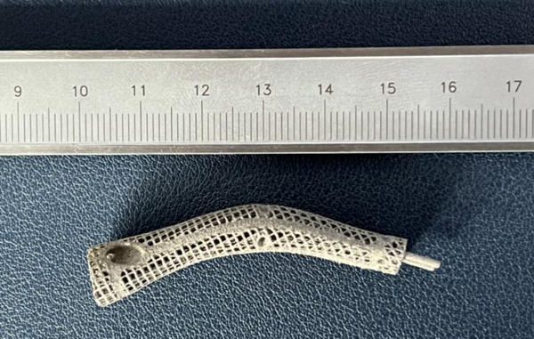 1732797225 946 3D printed titanium alloy prosthesis to treat finger bone defects