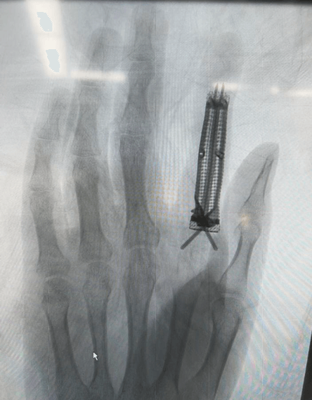 3d printed titanium alloy prosthesis to treat finger bone defects