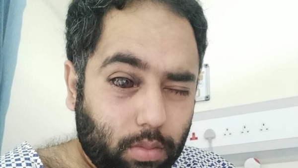 1732986833 354 UAE uses 3D printing technology to reconstruct patients eye socket
