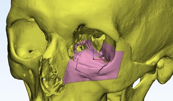 UAE uses 3D printing technology to reconstruct patient's eye socket