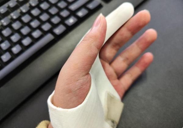 3D printed titanium alloy prosthesis to treat finger bone defects