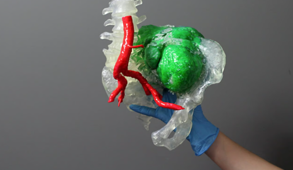 3D printing patient specific medical models becomes easier