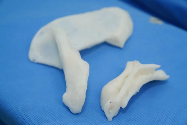 3D printing reverse shoulder replacement solves the problem of patients