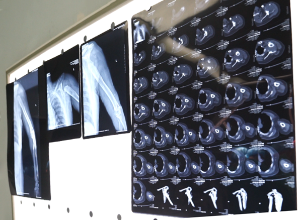 3D printing reverse shoulder replacement solves the problem of patients