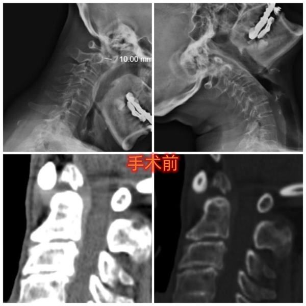 3D printing technology enables high risk atlantoaxial surgery