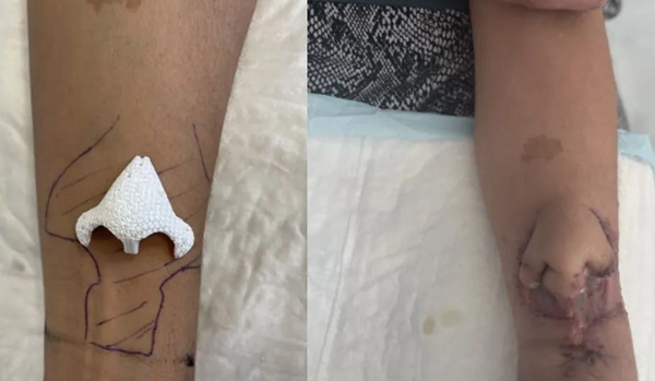 Cancer patient uses 3D printing technology to grow a new