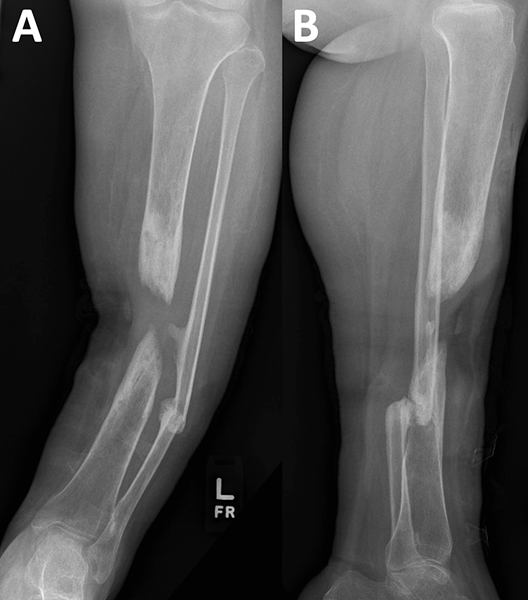 Custom 3D printed titanium cage successfully treats hard to heal bone structures due