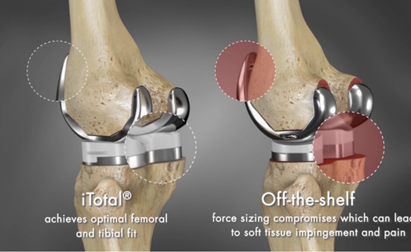 Restor3d acquires Conformis to jointly create a leader in personalized