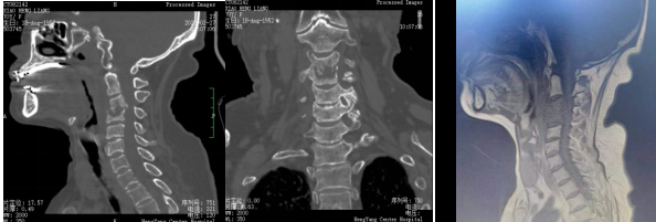 Significant breakthrough in 3D printing technology for spine surgery