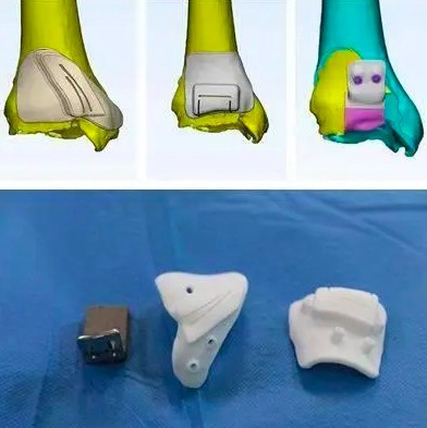 1733180428 151 3D printing makes it possible to complete the partial replacement