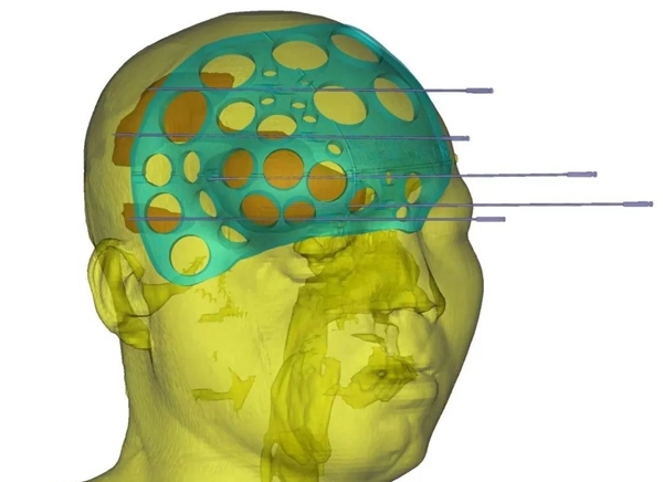 implantation and radiotherapy for recurrent head and neck tumors guided