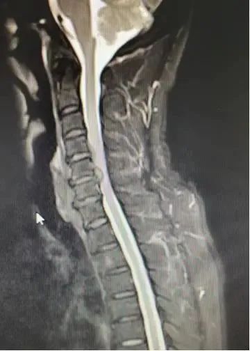 1733282388 1 3D Printed Porous Vertebral Body Cage Successfully Used in Anterior
