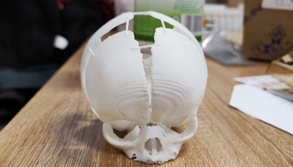 1733591894 258 3D printing helps save newborn with cranial defect