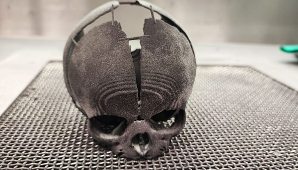 1733591895 800 3D printing helps save newborn with cranial defect