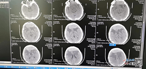 hospital successfully removed huge brain tumor using 3d printing technology