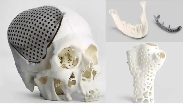 Applications and limits of 3D printing in orthopedics
