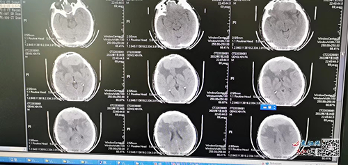Hospital successfully removed huge brain tumor using 3D printing technology