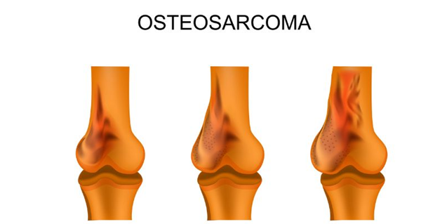 3D printed bone implants for the treatment of infant tumors